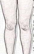 天津维美医疗美容做的吸脂瘦大腿怎么样？来看看术后3个月果