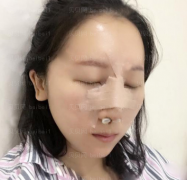 深圳广尔美丽医疗美容医院王天国膨体隆鼻介绍片较新分享_很期待我的鼻子后面恢复好的样子！