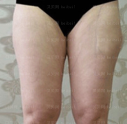 深圳美莱医疗美容医院郭杰大腿吸脂介绍片较新分享_好期待自身腿瘦几圈的模样！