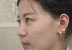 深圳美莱医疗美容医院梁志为双眼皮介绍片较新分享_看着眼晴已经变得越来越好了，真的是激动呢！