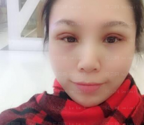 深圳美莱医疗美容医院李战强双眼皮介绍片较新分享_恢复的这么好也是预料之中的事情。