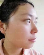 深圳臻瑞芝美医疗美容门诊部李远宏激光祛斑介绍片较新分享——我的皮肤现在已经恢复的越来越好了呢，而且之前的肤色不均、毛孔粗大等情况也都改
