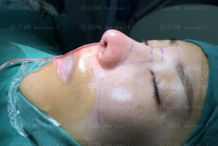 深圳臻瑞芝美医疗美容门诊部慕昕肋软骨隆鼻介绍片较新分享——鼻子已经恢复的比较自然了，感觉越来越好看了呢