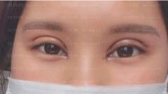 深圳臻瑞芝美医疗美容门诊部慕昕双眼皮介绍片较新分享——恢复到现在，眼睛看起来真的是越来越好看了
