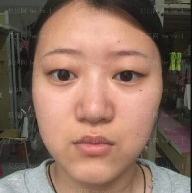 广州市荔湾区人民医院整形美容科,齐云香埋线双眼皮介绍,比我想象的要好看，真的是太满足了