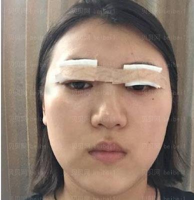 广州市荔湾区人民医院整形美容科,齐云香埋线双眼皮介绍,比我想象的要好看，真的是太满足了